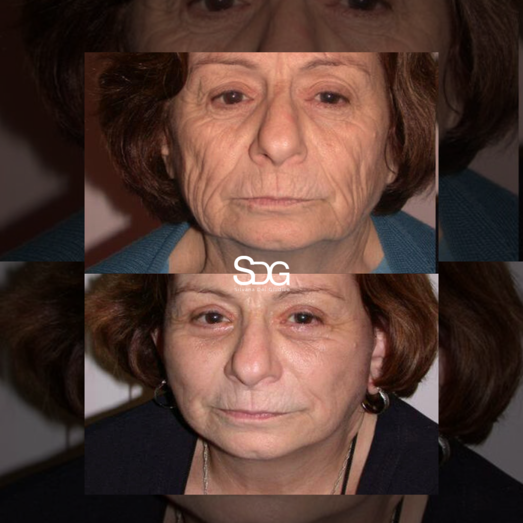 ¿Cómo funciona realmente un lifting facial? Claves para un resultado natural