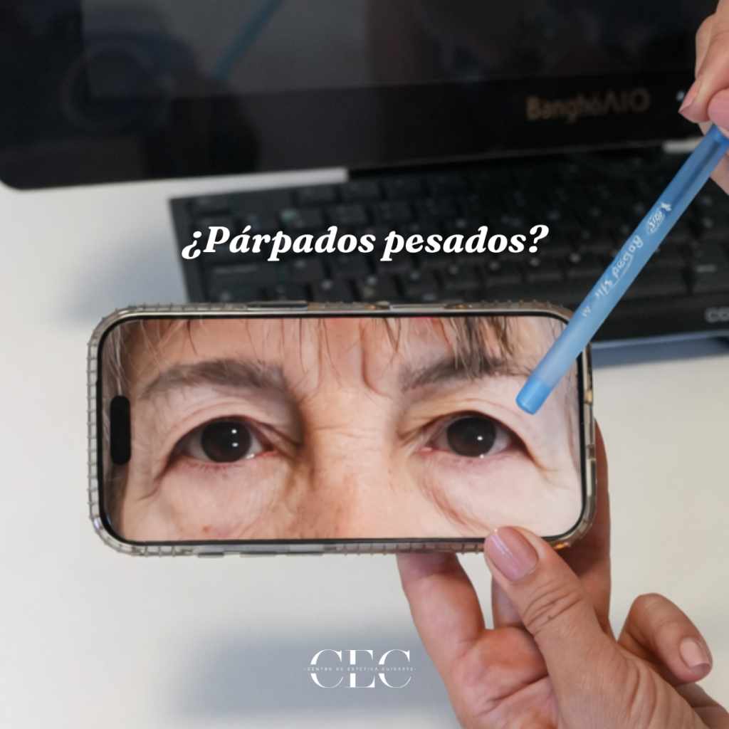Párpados pesados: cuándo el exceso de piel puede ser un problema funcional