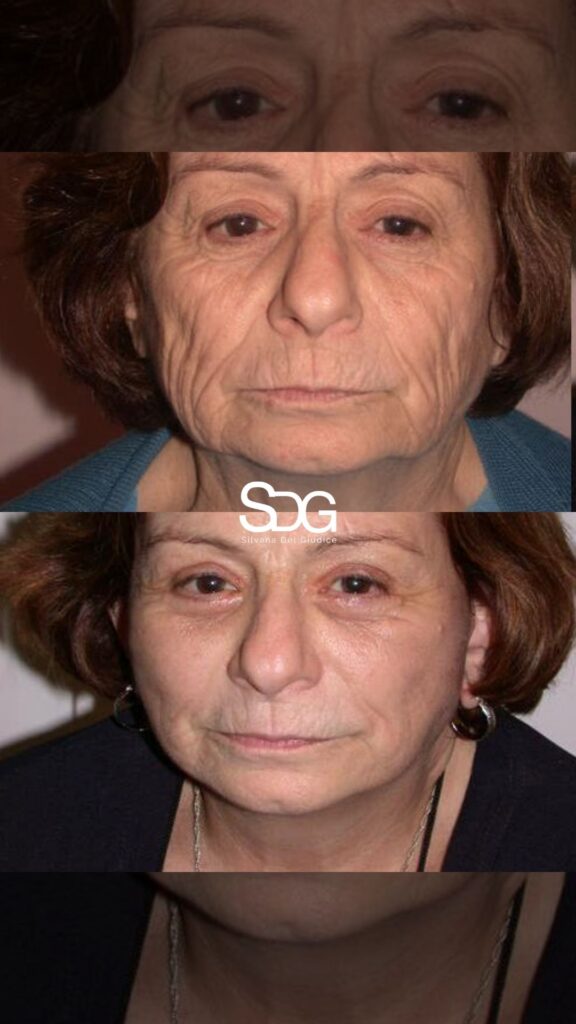 ¿Cómo funciona realmente un lifting facial? Claves para un resultado natural